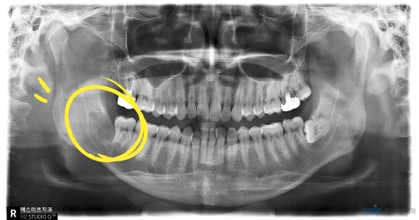 사랑니 발치, 꼭 빼야 할까요? - 사랑니 발치 관련 이미지 2
