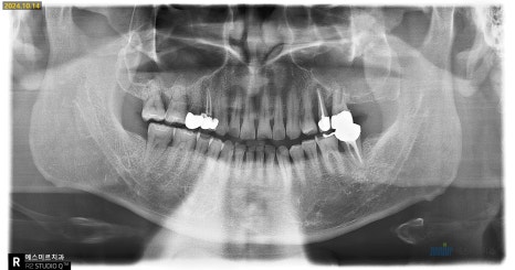 잇몸 염증이 코까지 번졌다고요? - 상악동거상술 + 뼈이식 관련 이미지 11