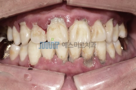 🦷 내 치아를 오래 지키고 싶다면? 잇몸치료가 필요해요 관련 이미지 1