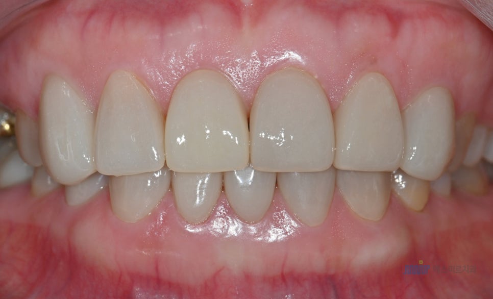 ✨앞니 색상, 자연스럽게? 새하얗게? 고민된다면 - 미라클네이트 관련 이미지 9