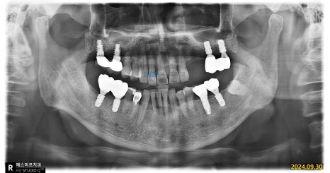임플란트가 흔들려요 - 임플란트 재수술 관련 이미지 1