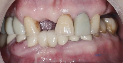 🦷 임플란트 수술 전 과정을 생중계로! &ndash; 예스미르치과 x 덴올TV 관련 이미지 14