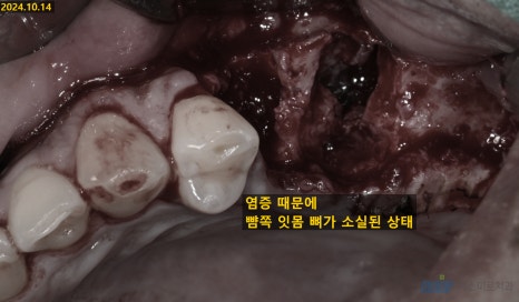 잇몸 염증이 코까지 번졌다고요? - 상악동거상술 + 뼈이식 관련 이미지 5