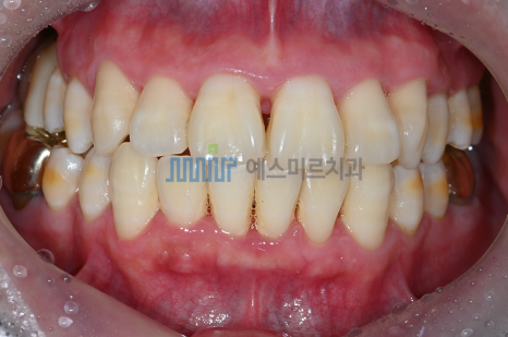 🦷 내 치아를 오래 지키고 싶다면? 잇몸치료가 필요해요 관련 이미지 2