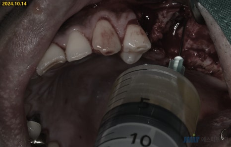 잇몸 염증이 코까지 번졌다고요? - 상악동거상술 + 뼈이식 관련 이미지 4