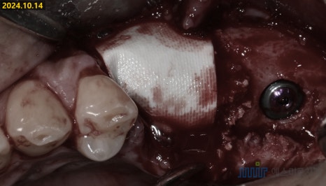 잇몸 염증이 코까지 번졌다고요? - 상악동거상술 + 뼈이식 관련 이미지 8