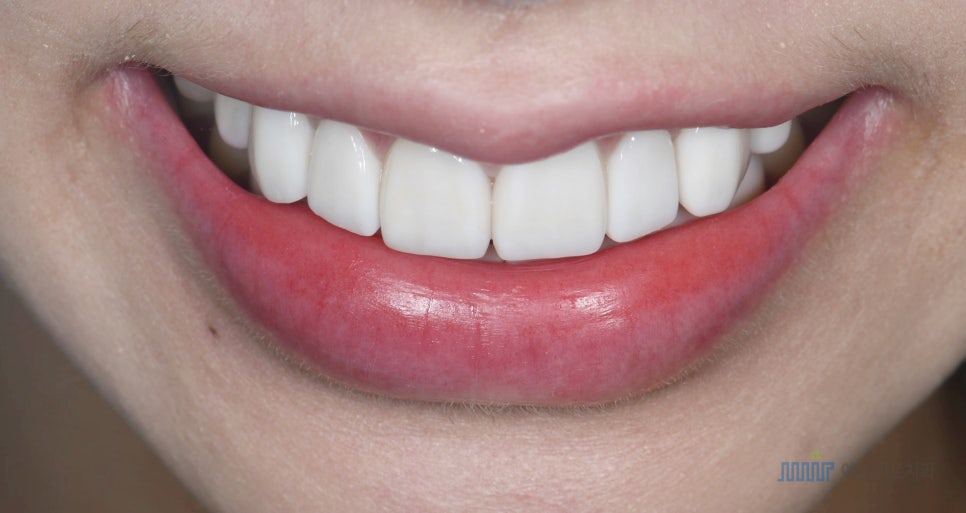 ✨앞니 색상, 자연스럽게? 새하얗게? 고민된다면 - 미라클네이트 관련 이미지 7