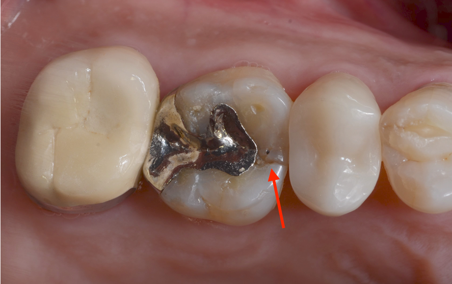 금이 간 치아! 치아를 잃을 뻔 했던 순간, 예스미르치과 관련 이미지 1
