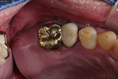 잇몸 염증이 코까지 번졌다고요? - 상악동거상술 + 뼈이식 관련 이미지 13