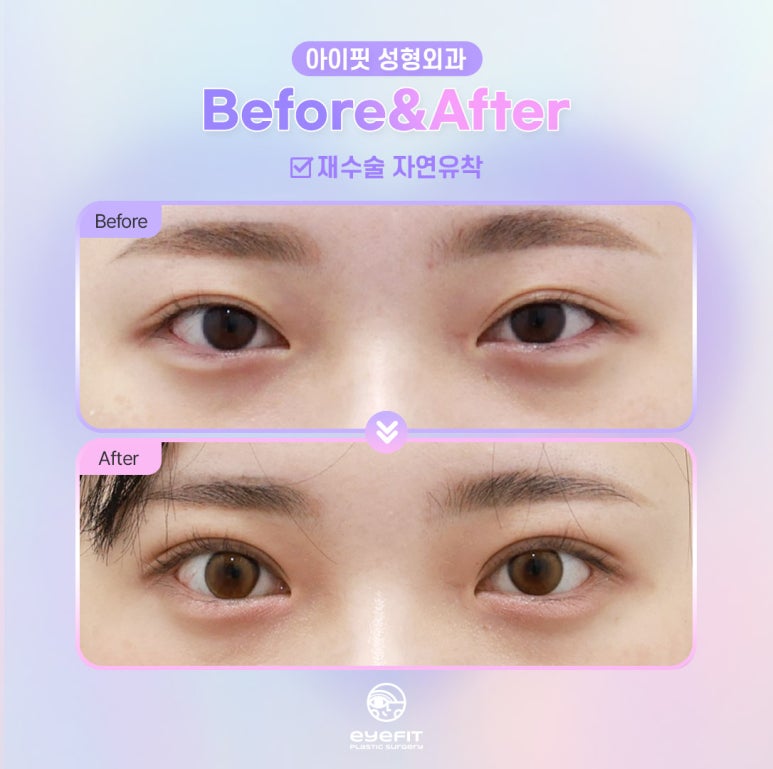 A Great Place for Revision Eye Surgery, Eyefit Plastic Surgery! image 3