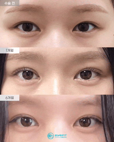 [Eyefit Plastic Surgery] Natural Adhesion Before and After Real Video🩵 image 1