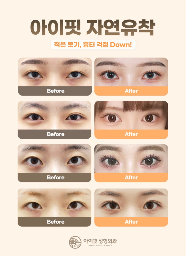 [I-Fit Plastic Surgery] Natural Adhesion Q&A (ft. Recommended Types for Natural Adhesion) image 2