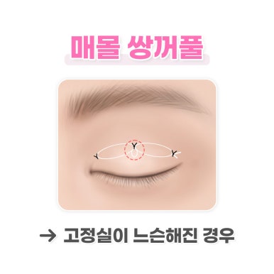 [Double Eyelid Dissolving] Why Does It Happen? From Causes to Solutions! image 2