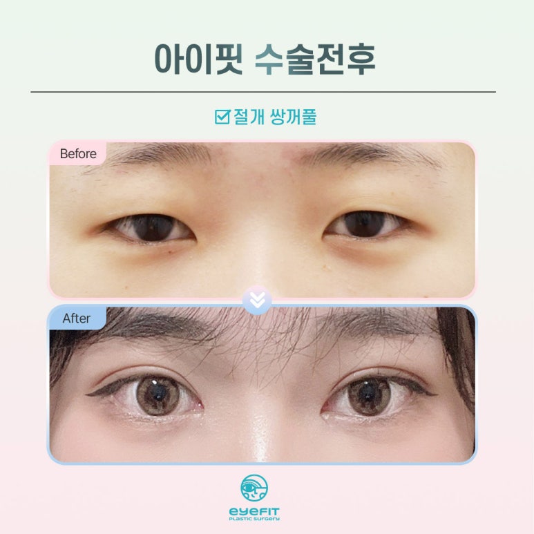 Have You Seen an Incision Double Eyelid This Natural? image 2