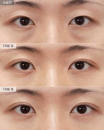 [Eyefit Plastic Surgery] Real Before-and-After Video: Lower Eyelid Fat Repositioning + Natural Adhesion image 2