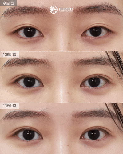 [아이핏성형외과]자연유착 재수술 리얼영상🩵 관련 이미지 1