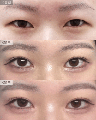 [Eyefit Plastic Surgery] Natural Adhesion Revision Surgery, Fat Removal Real Video🩵 image 1