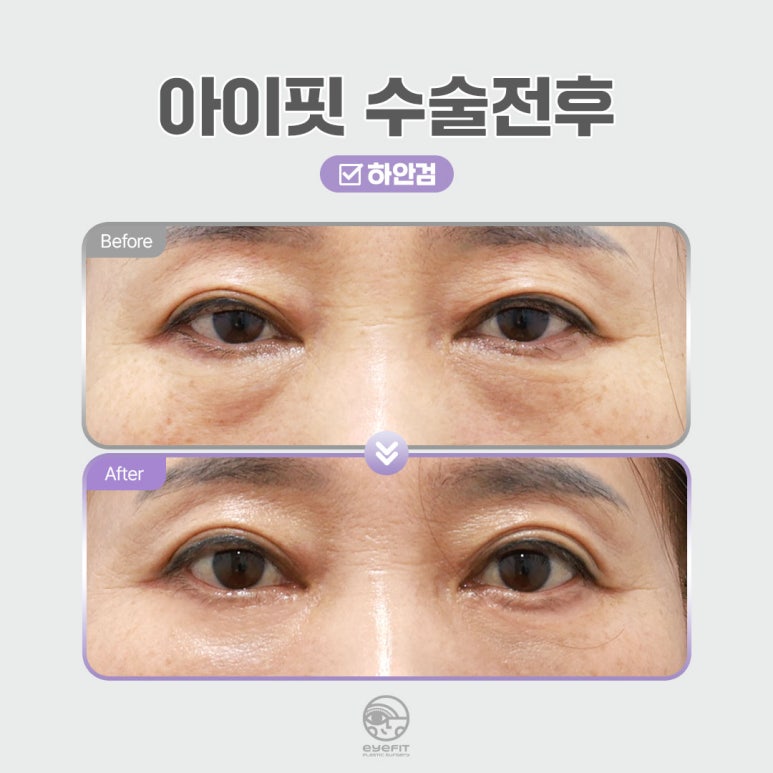 [Eyefit Plastic Surgery] Curious About the Difference Between Lower Eyelid Fat Repositioning and Lower Blepharoplasty? image 6