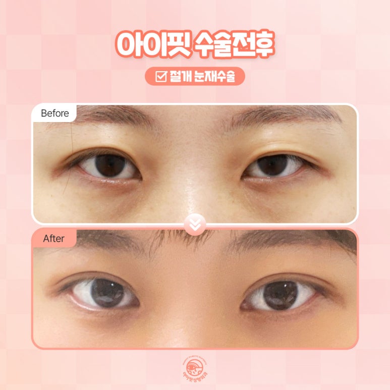 A Great Place for Revision Eye Surgery, Eyefit Plastic Surgery! image 5