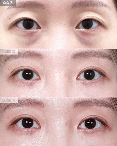 [아이핏성형외과] 풀린 눈 재수술(자연유착 재수술), 눈밑지방재배치 리얼영상 관련 이미지 1
