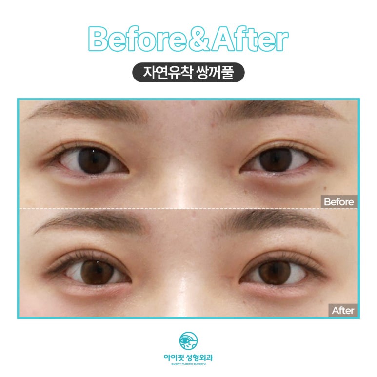 아이핏성형외과 자연유착 관련 이미지 3