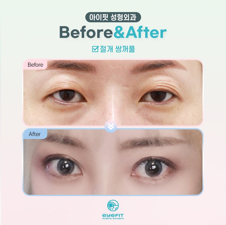 Have You Seen an Incision Double Eyelid This Natural? image 4