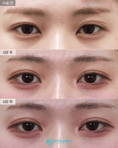 [아이핏성형외과] 자연유착 리얼영상🩵 관련 이미지 1