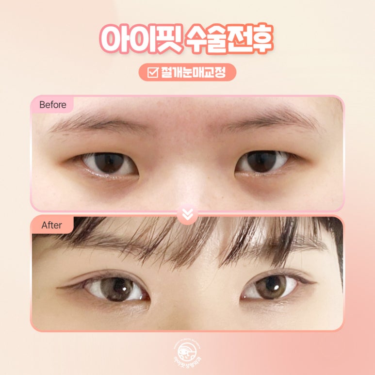 [아이핏성형외과] 절개눈매교정 전후 또렷한 눈매로 관련 이미지 3