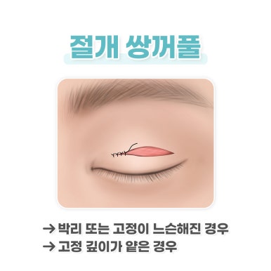 [Double Eyelid Dissolving] Why Does It Happen? From Causes to Solutions! image 3
