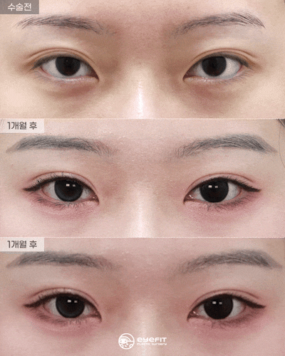 겹주름 개선, 자연유착 1개월 전후 [아이핏성형외과] 관련 이미지 2
