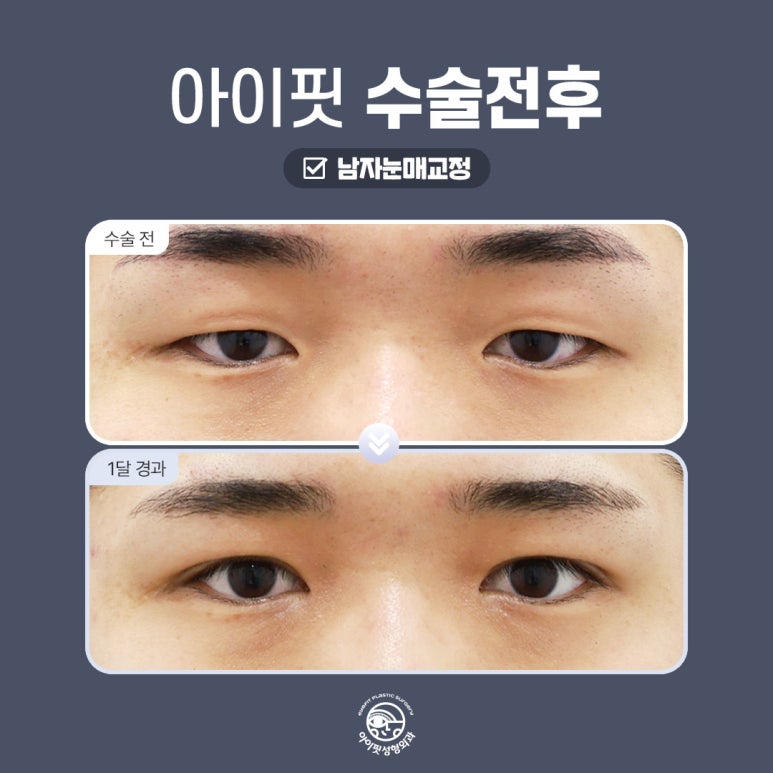 [아이핏 성형외과] 남자눈매교정으로 또렷하고 선명하게 관련 이미지 5