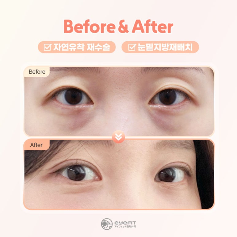 아이핏성형외과 | 자연유착&middot;절개 쌍꺼풀 재수술 케이스 관련 이미지 1
