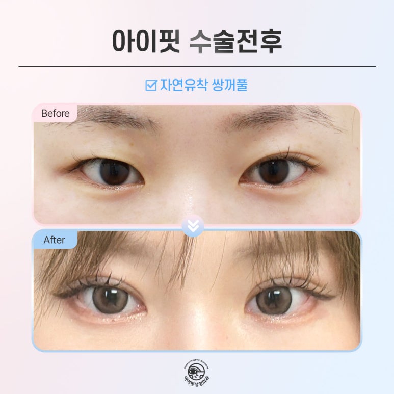 [Eyefit Plastic Surgery] Natural and lively with natural adhesion double eyelid surgery! image 4