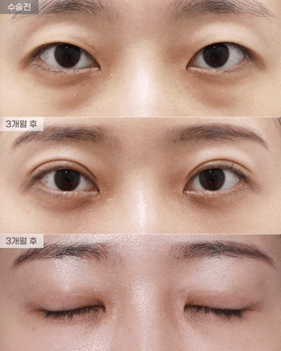 [아이핏성형외과] 자연유착+눈밑지방재배치 리얼 전후 관련 이미지 2