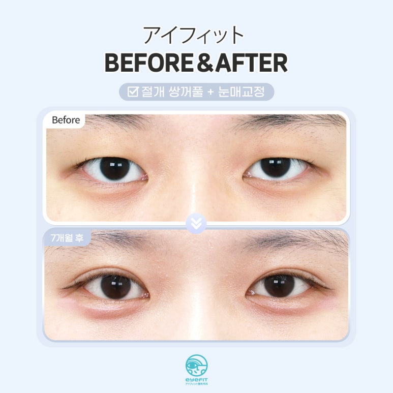 [Eyefit Plastic Surgery] When the eyes lack the strength to open, make them clearer with eye correction image 5