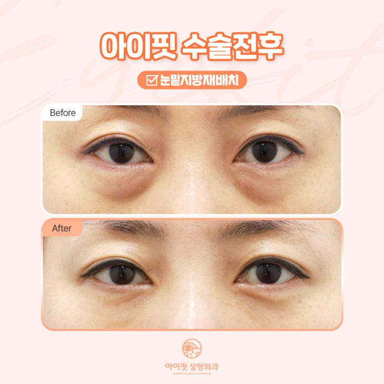 [아이핏 성형외과] 아이핏 눈밑지방재배치, 어떤 다를까? 관련 이미지 4