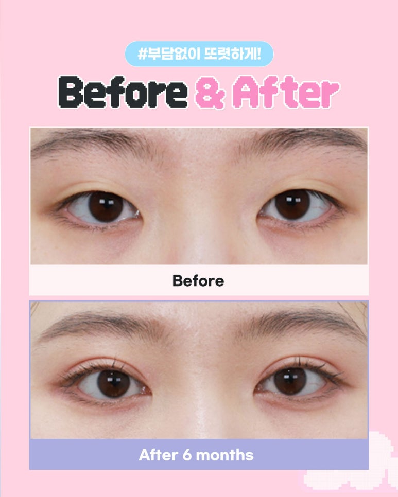 Eyefit Plastic Surgery 2026 Exam-Taker Eye Surgery Discount Event🌟 image 2