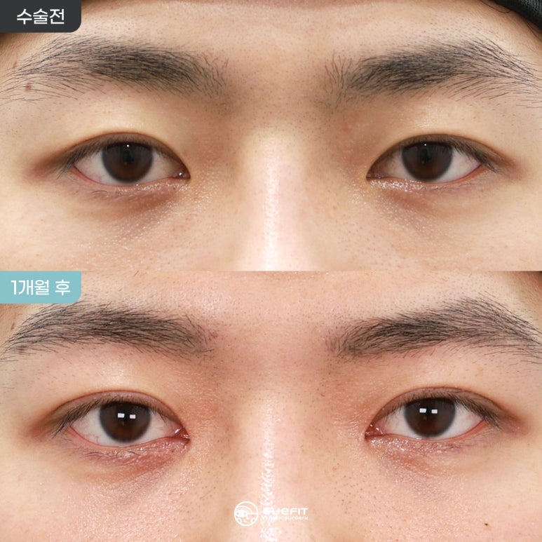 Male Double Eyelid Revision with Natural Adhesion + Medial Canthoplasty: 1-Month Before and After [Eyefit Plastic Surgery] image 1
