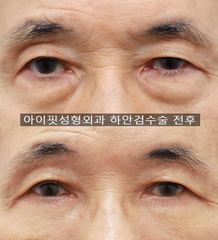 The Jewel of Midlife Eye Surgery: Lower Blepharoplasty image 4
