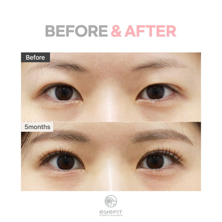 [Double Eyelid Dissolving] Why Does It Happen? From Causes to Solutions! image 6