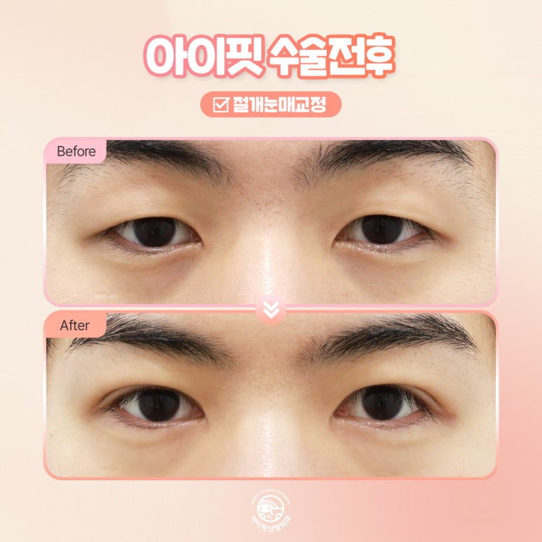 [아이핏성형외과] 절개눈매교정 전후 또렷한 눈매로 관련 이미지 5