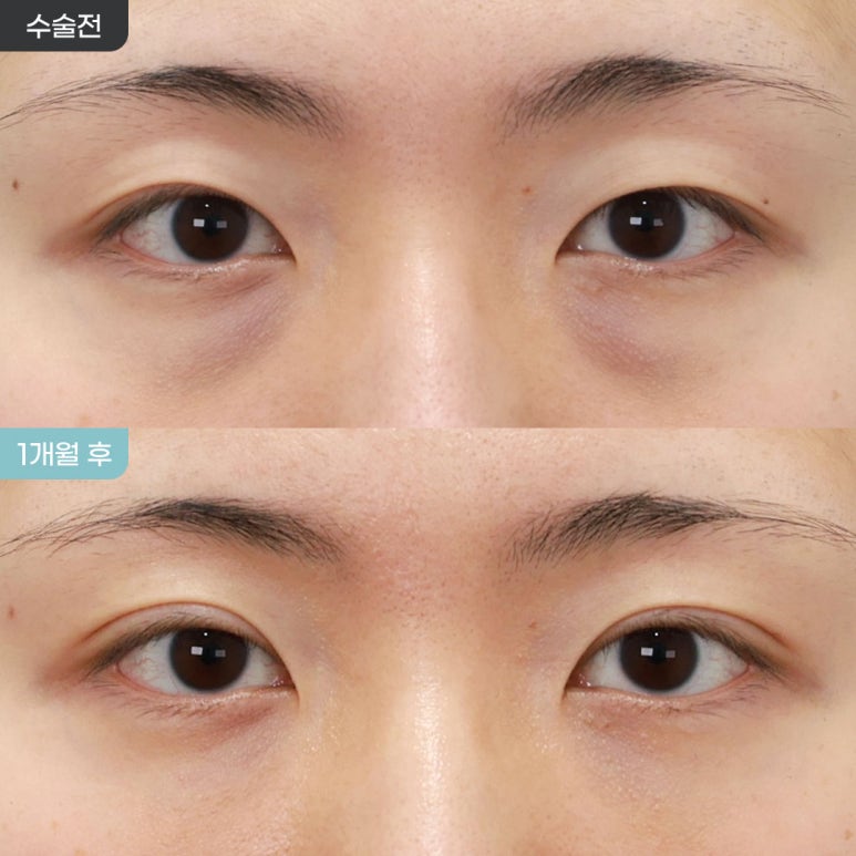 [Eyefit Plastic Surgery] Real Before-and-After Video: Lower Eyelid Fat Repositioning + Natural Adhesion image 1