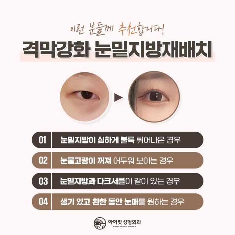 아이핏성형외과 격막강화 눈밑지방재배치 관련 이미지 1