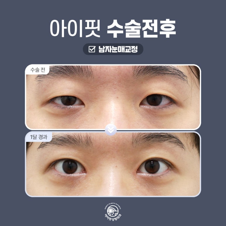 [아이핏 성형외과] 남자눈매교정으로 또렷하고 선명하게 관련 이미지 6