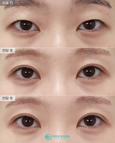 [EYEFIT Plastic Surgery] One-Month Natural Adhesion Real Video 🩵 Before-and-After Comparison of the In-Out Line image 1