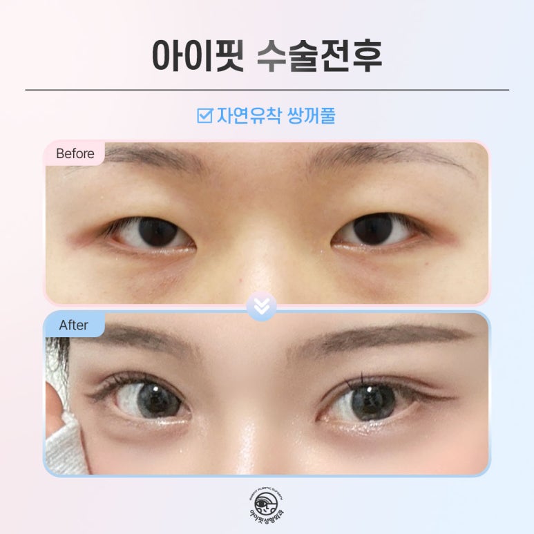 [Eyefit Plastic Surgery] Natural and lively with natural adhesion double eyelid surgery! image 5
