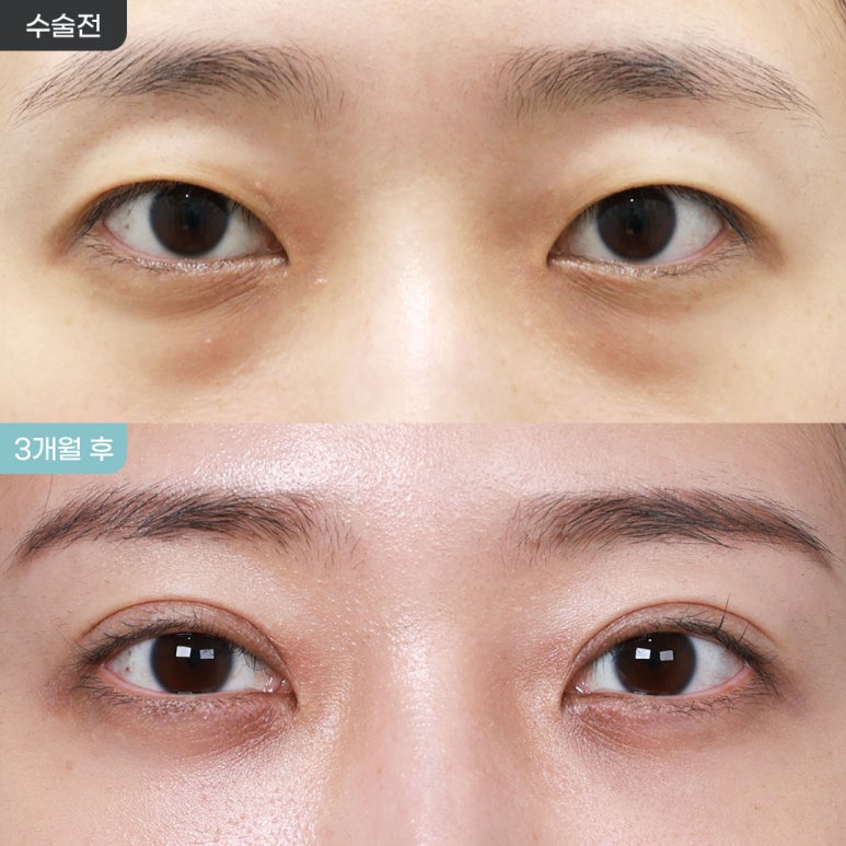 [아이핏성형외과] 자연유착+눈밑지방재배치 리얼 전후 관련 이미지 1