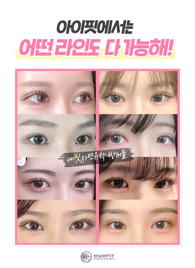 Why Is EyeFit Natural Adhesion Double Eyelid Surgery So Popular? image 3