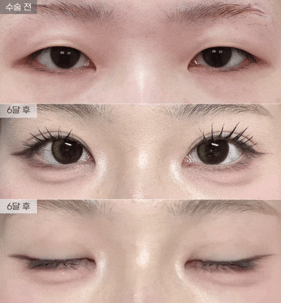 [아이핏성형외과]풀린 쌍꺼풀 자연유착 재수술, 앞트임 리얼 영상🩵 관련 이미지 1