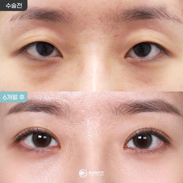 Natural-Adhesion Double Eyelid Surgery + Lower-Eyelid Fat Repositioning: Before and 6 Months After [Eye Fit Plastic Surgery] image 1